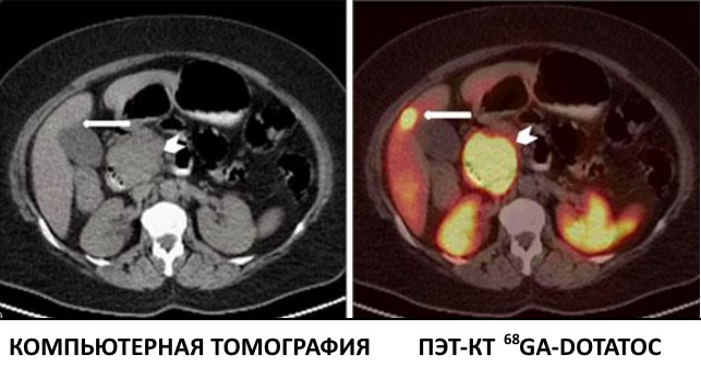 ПЭТ-КТ DOTATOC новые методы обследования при онкологии