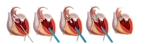 Лечение стеноза аортального клапана в Германии